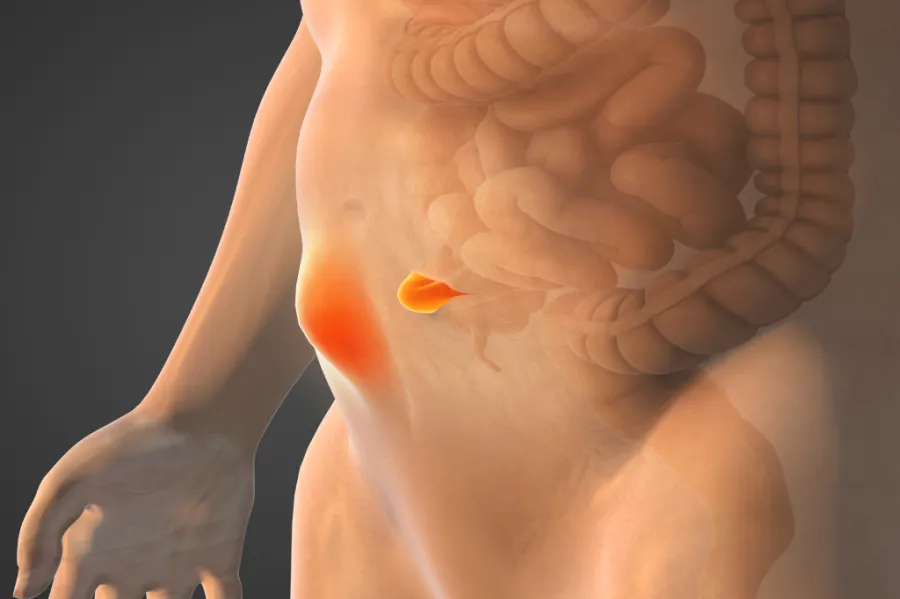 An illustration of a hernia