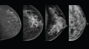 Mammogram