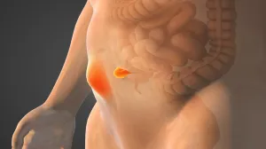 An illustration of a hernia