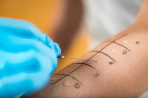 Closeup of a patient's arm and a doctor performing a skin prick allergy test during an appointment.