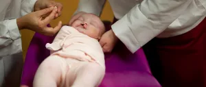 Doctors working on a baby with a cleft lip and palate